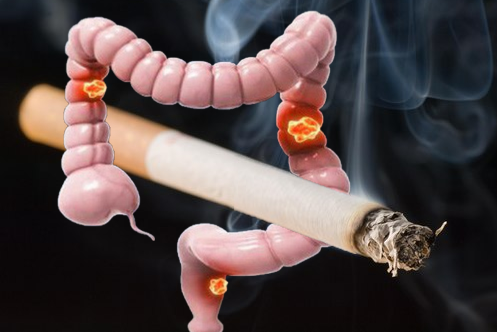 Mối liên hệ giữa hút thuốc lá và ung thư đại trực tràng